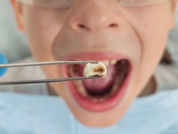 Urgent Tooth Repair in TX